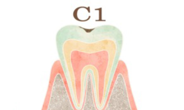歯の表層のエナメル質に限局した虫歯（C1）のイラスト