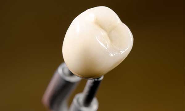 セラミッククラウンの写真