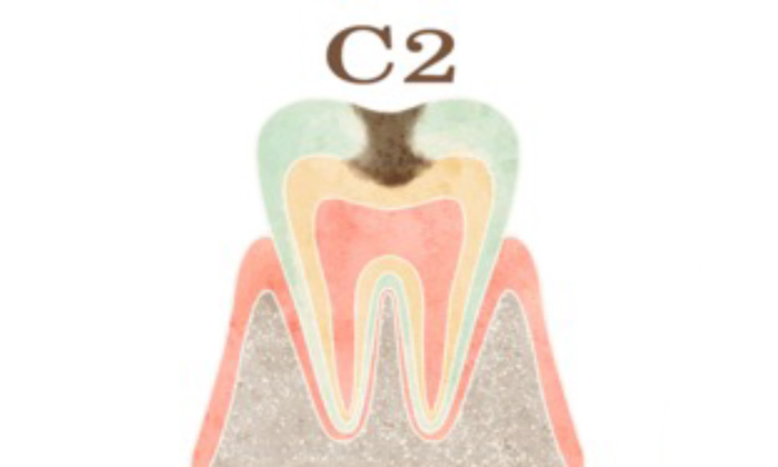 エナメル質を越え、象牙質まで達した虫歯（C2）のイラスト