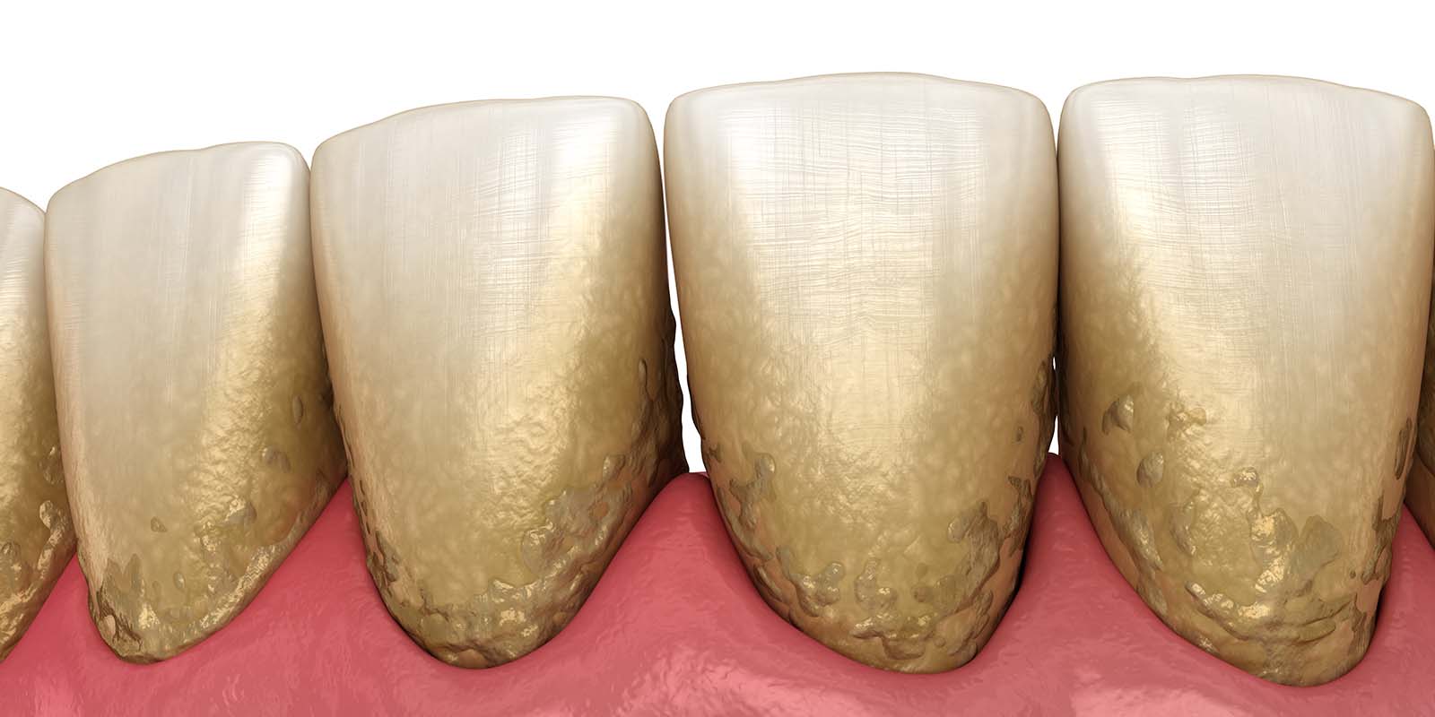 汚れが付着している口の中のイメージ画像