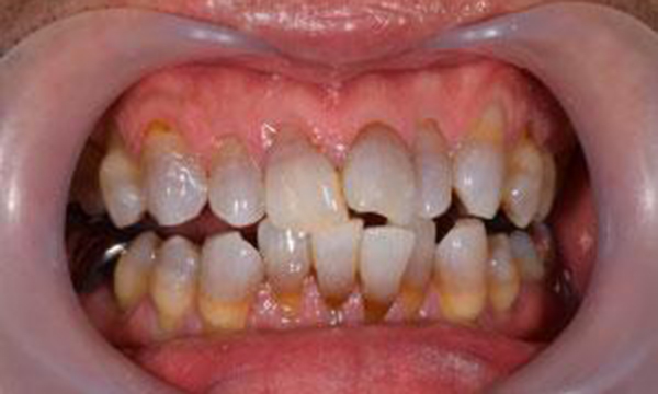 薬の副作用により変色してしまった歯がある口腔内写真