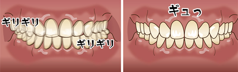 ギリギリと歯ぎしりをしている様子と、ギュっとかみしめている様子のイラスト