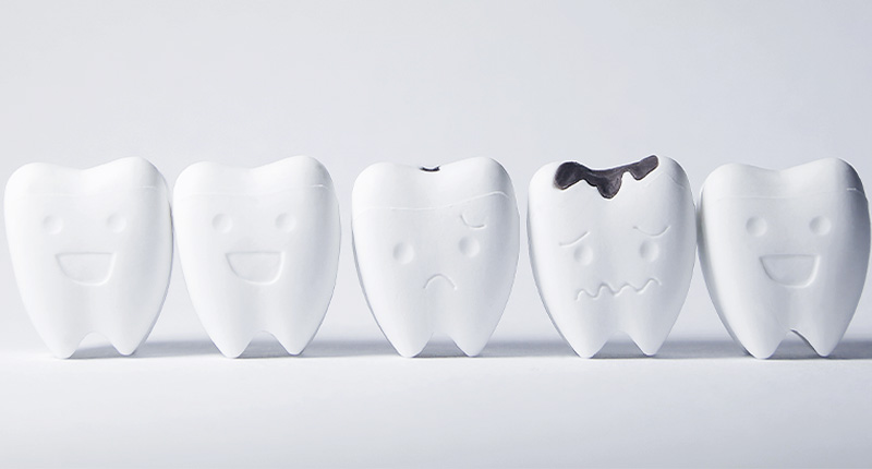 5本並ぶ歯の模型の内1本が虫歯になっている画像