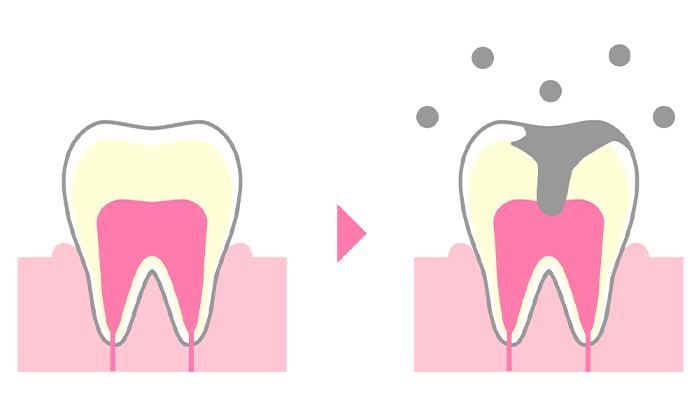 綺麗な歯から虫歯を放置し黒くなった歯のイラスト