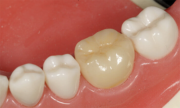 東松原歯科のオールセラミック