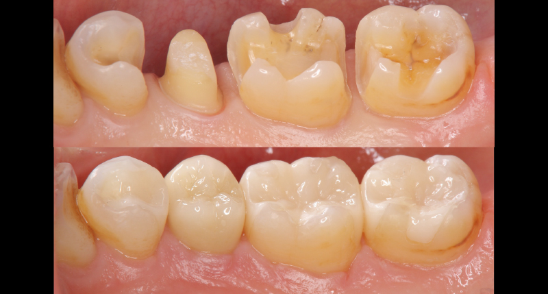 詰め物や被せ物が入る前とセット後それぞれの比較画像