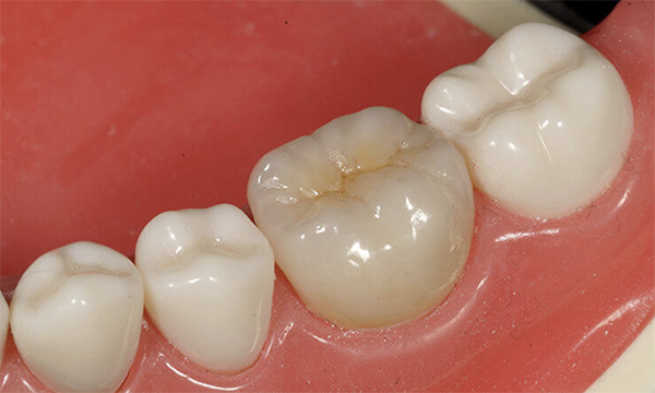 東松原歯科のジルコニア