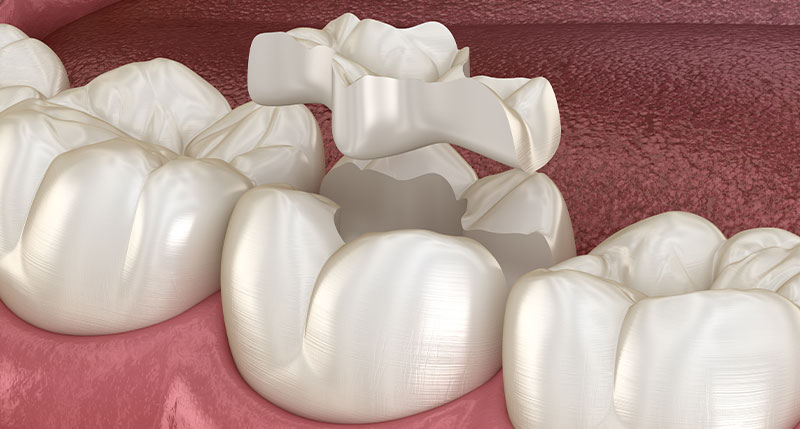 インレーを歯に装着するイメージ
