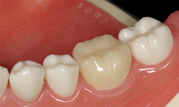 東松原歯科のCADCAM冠