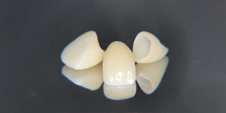 前歯のセラミックの補綴物の写真