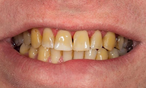 加齢による着色をした口腔内写真