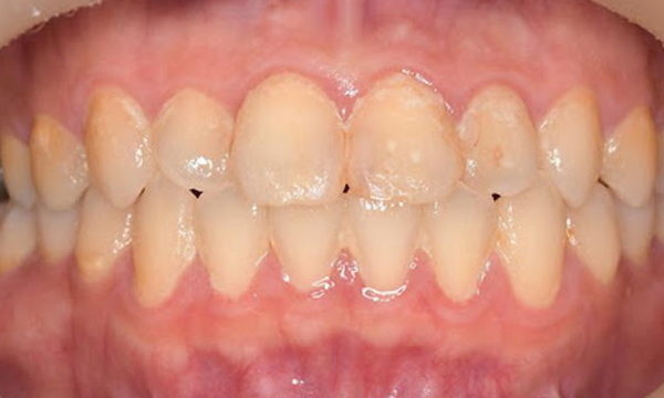 プラークや歯石の付着した口腔内写真