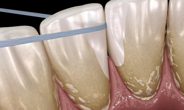 デンタルフロスで歯と歯の間を掃除するイメージイラスト