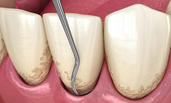 歯ぐきの奥にある歯石を専用の器具で除去するイメージイラスト