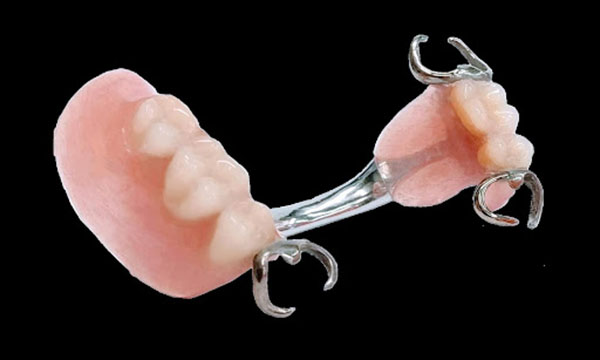 繋がった左右奥歯の部分入れ歯