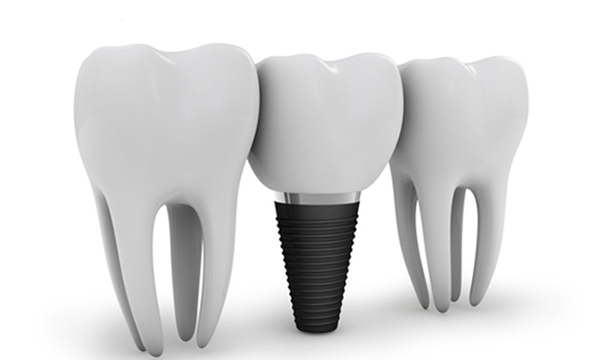 寝ている間にインプラントのイメージ