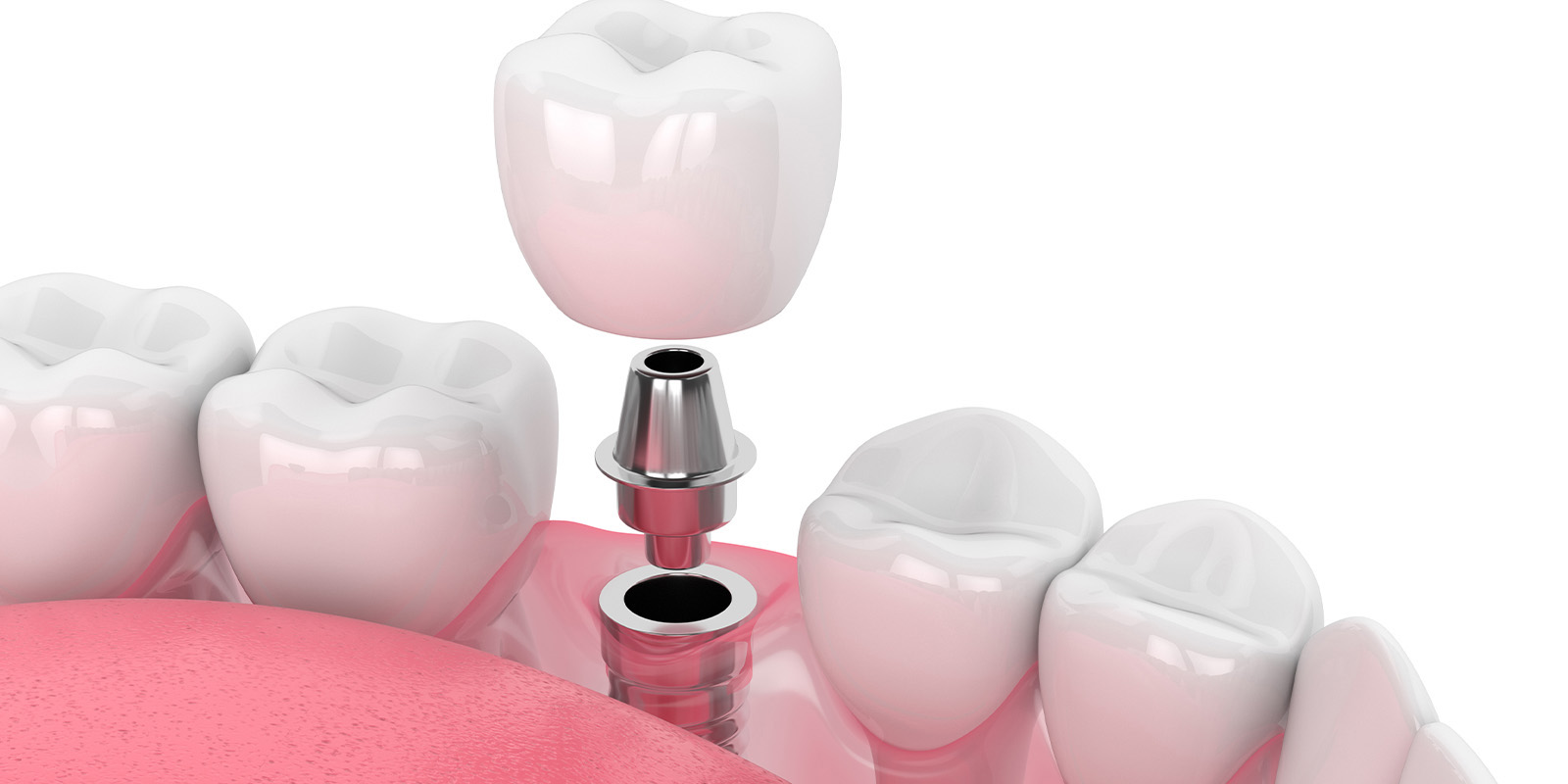 東松原歯科のインプラント体の装着イメージ