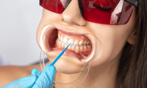 オフィスホワイトニングを受ける女性のイメージ