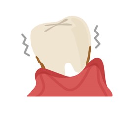 歯周病により揺れが強くなってしまった歯のイメージイラスト歯並びが凸凹している方の上の歯の写真