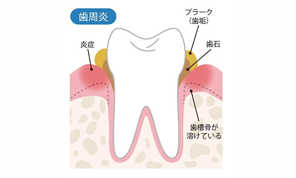 歯周炎のイメージイラスト