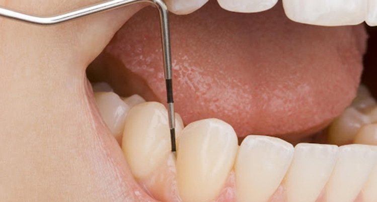 歯周病検査を受けている様子