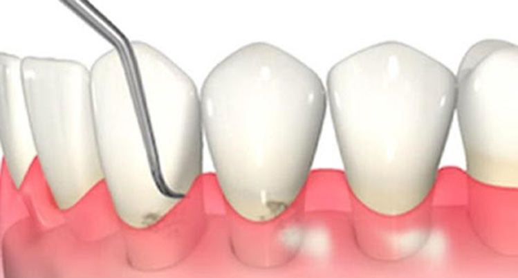 歯と歯茎の間の汚れをかき出すイメージイラスト