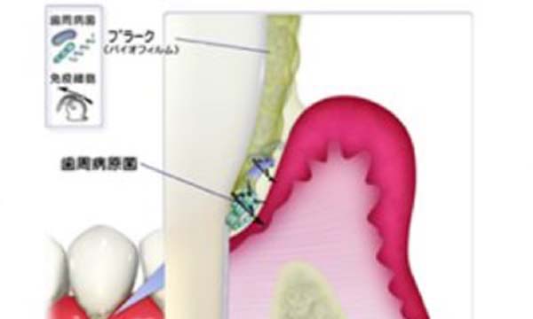 歯と歯ぐきの断面図にプラーク（バイオフィルム）や歯周病原菌が付着して歯ぐきが腫れている様子