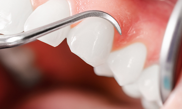 歯ぐきの状態をチェックされているイメージ