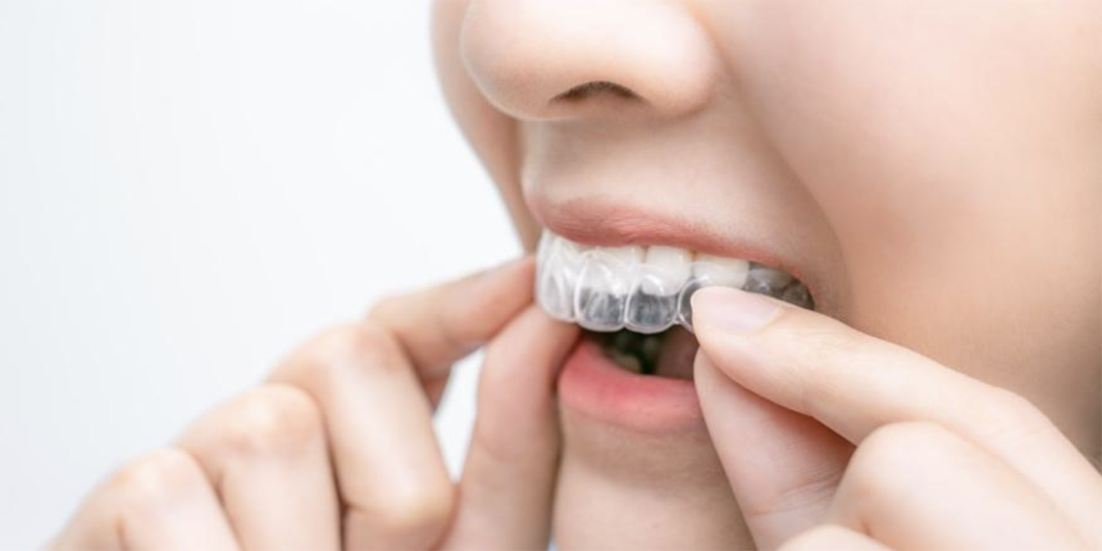 マウスピースをはめる様子の口元の写真