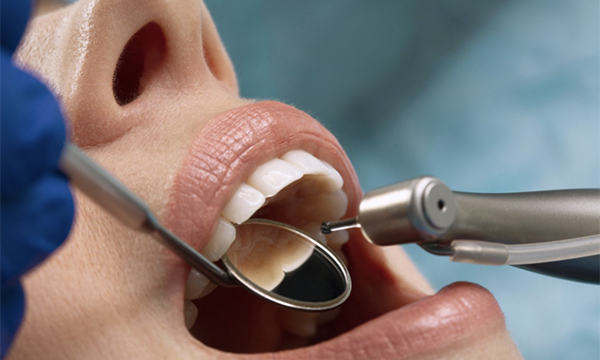 歯を削る機械を歯に近づけている様子の口元の写真