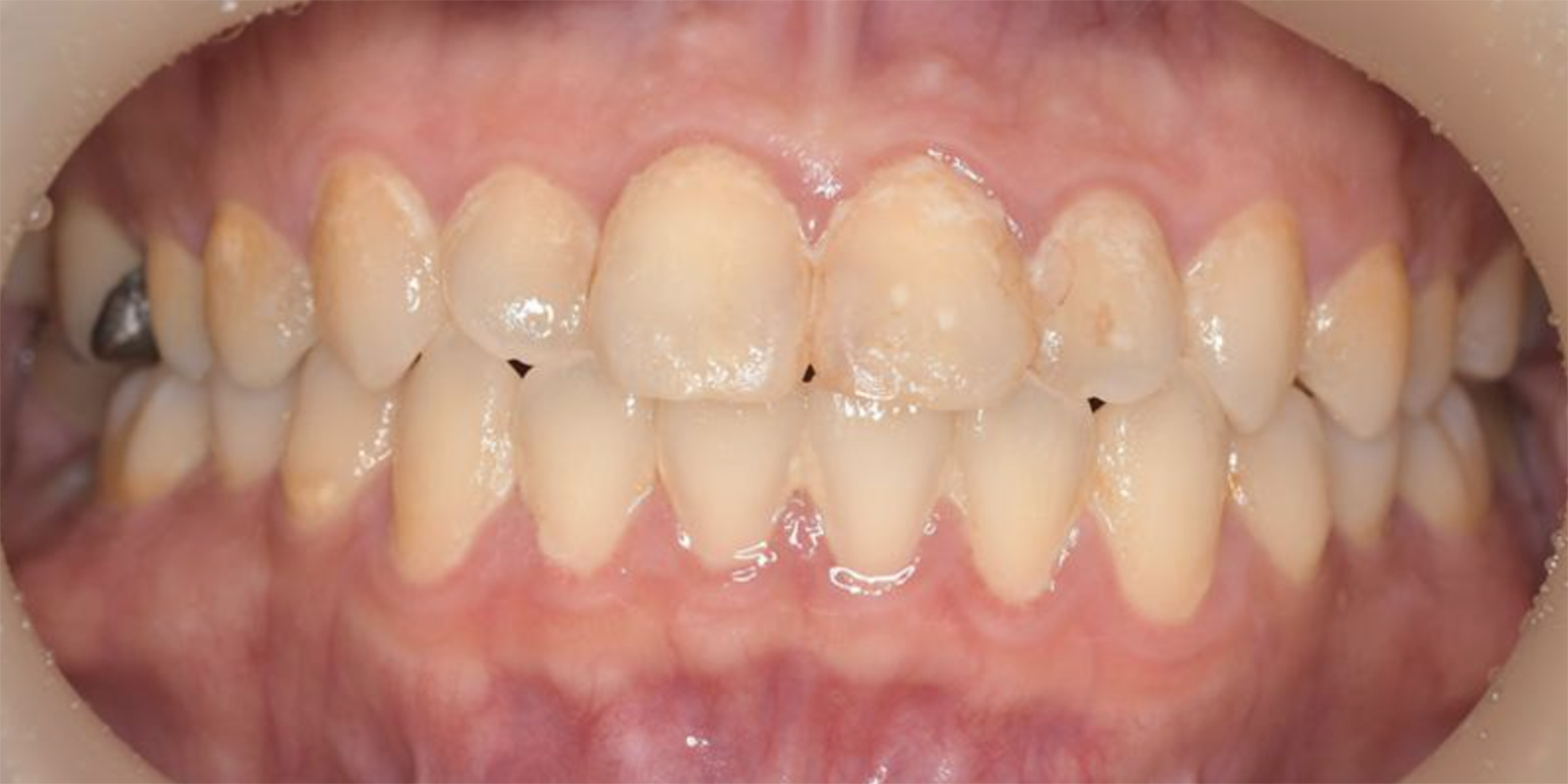 歯垢が付着し、汚れているお口の中の写真