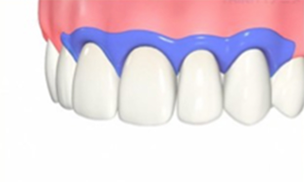 歯ぐきと歯の境目を樹脂の材料で保護している状態のイメージ