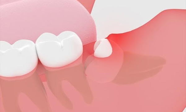 半分頭が出ている親知らずのイラスト