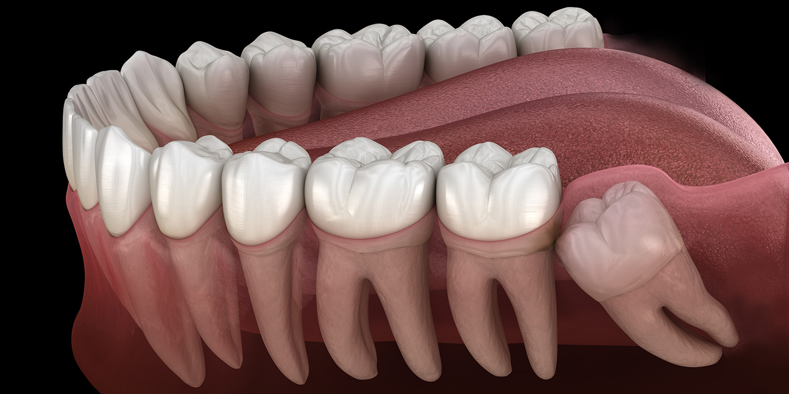 完全に埋まっている親知らずのイメージ