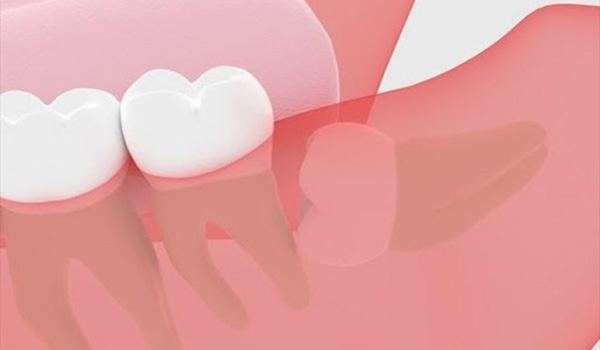 完全に埋まっている親知らずのイラスト