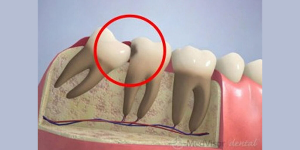 親知らずが手前の歯にぶつかって生えているために、手前の歯が虫歯になってしまっているイメージ