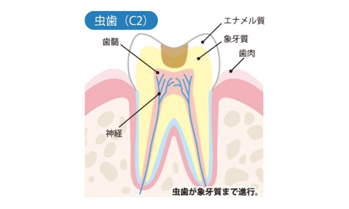 虫歯が象牙質まで進行している歯のイラスト