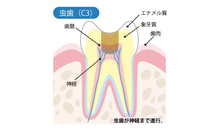 虫歯が神経まで進行している歯のイラスト