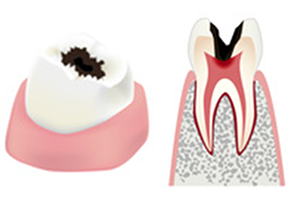 象牙質を越え神経にまで虫歯が達してしまった歯（C3）のイメージ